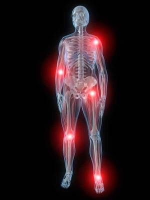 Ovih 8 simptoma ukazuju da možda bolujete od reumatoidnog artritisa