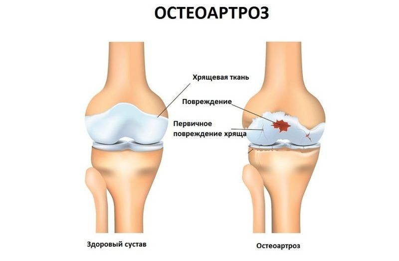 neke masti u liječenju osteoartritisa)