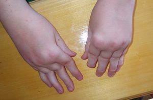 kako liječiti bol u zglobovima kod djece