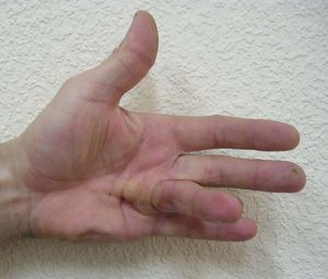 uzrok boli u zglobu prsta na ruci liječenje bolova u mišićima u ramenskom zglobu